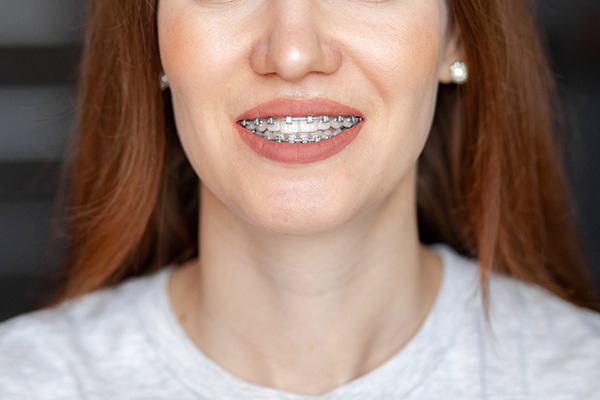 Dental Teeth Straightening Can Help To Prevent Plaque Build Up