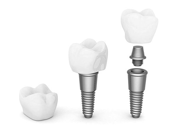 If You Are Interested In Dental Implants In Delaware, Call Our Cosmetic Dentist Office