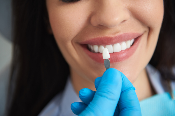 How Long Do Veneers Last? Tips For Maintaining Your New Smile