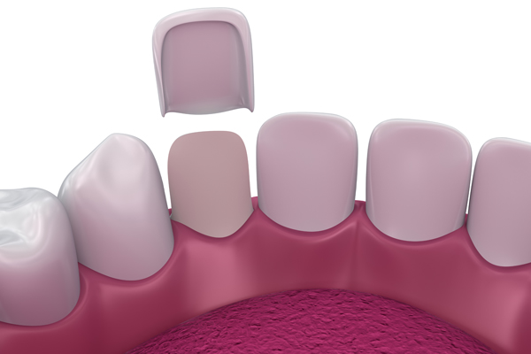Traditional Dental Veneers Vs  No Prep Veneers: Differences To Keep In Mind