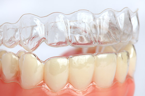 Lake Erie Dental Blog  Clear Braces for a Modern Approach to Straight Teeth