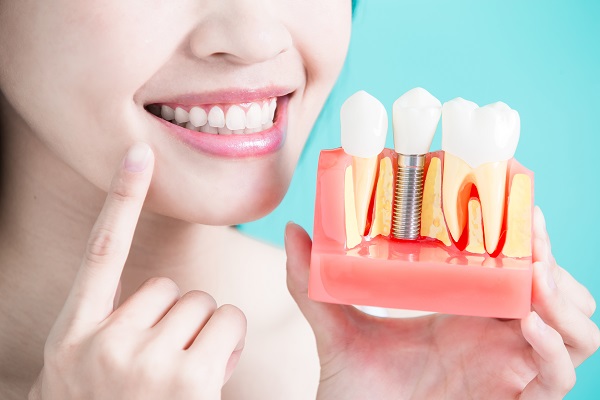 Implant Supported Dentures Step By Step