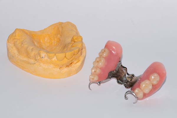Am I A Candidate For Partial Dentures?